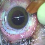 Fig. 5 Passaggio dell’ago 27 G in camera anteriore.