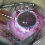 Fig. 6 Passaggio dei fili in prolene ancorati alla IOL attraverso l’ago 27 G e inserimento della IOL in camera anteriore..