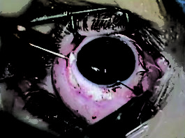 Fig. 6 Passaggio dei fili in prolene ancorati alla IOL attraverso l’ago 27 G e inserimento della IOL in camera anteriore.