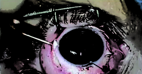 Impianto di IOL multifocali a fissazione sclerale in bambini affetti da Ectopia Lentis: sei anni di esperienza Fig. 6 Passaggio dei fili in prolene ancorati alla IOL attraverso l’ago 27 G e inserimento della IOL in camera anteriore.