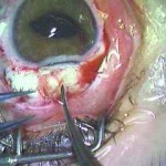 Fig. 7 Passaggio dei fili in prolene ancorati alla IOL attraverso l’ago 27 G e inserimento della IOL in camera anteriore.