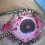 Fig. 8 Sutura degli sportelli sclerali.