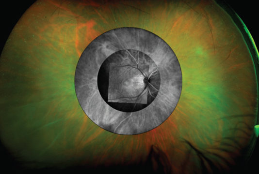 OPTOS California: la vera rivoluzione nella retinografia retinografia