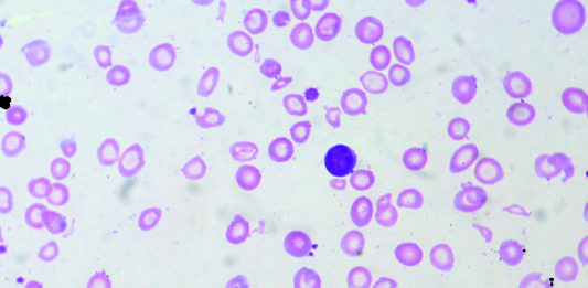 L’anemia sideropenica può indurre riduzioni nello spessore coroidale