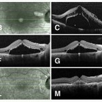 guarigione_distacco_maculare