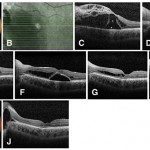 guarigione_distacco_maculare2