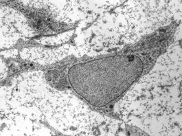 Impiego di cellule staminali mesenchimali per il trattamento delle patologie oculari
