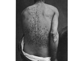 Psoriasi e insorgenza di uveite: dimostrata l’esistenza di una reciproca interdipendenza