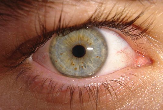 Congiuntiviti allergiche