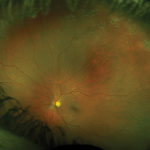 Retinografia wide-field