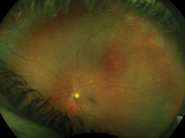 Retinografia wide-field