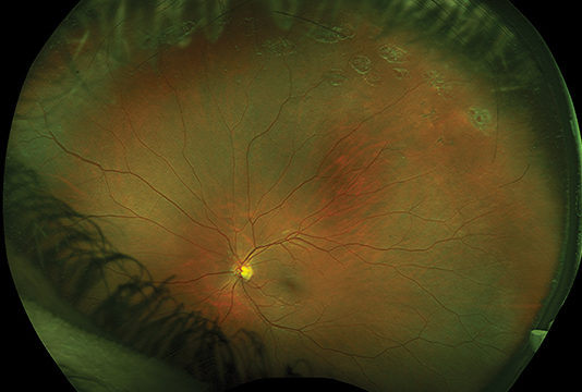Retinografia wide-field