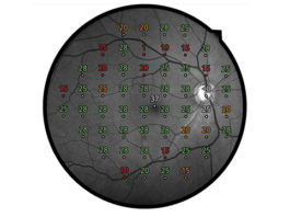 COMPASS Fundus Automated Perimetry