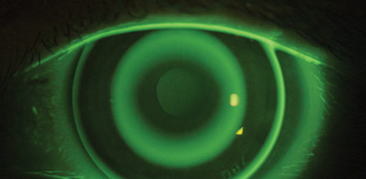 Prevalenza globale di miopia dal 2000 al 2050: ecco i trend temporali miopia