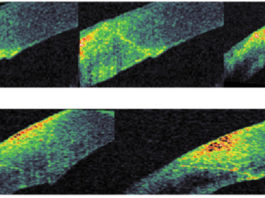Incisioni corneali e analisi con OCT