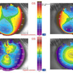 Occhio sinistro: topografia preoperatoria