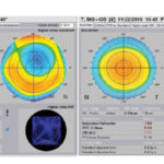 livello-aberrometrico