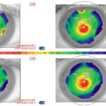 Fig. 1: esempio di “stabilità inquieta”, con notevoli modifiche topografiche in 7 anni.