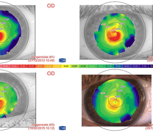 CXL EPI-OFF valutazione clinica a 24 mesi su 500 casi di cheratocono