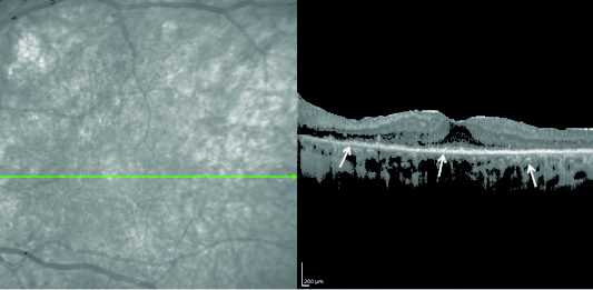 Sindromi masquerades: Optical coherence tomography di un soggetto affetto da linfoma vitreoretinico primario. Gli infiltrati linfomatosi sono evidenziati dalle frecce come materiale granulare iperriflettente sottoretinico e sotto l’epitelio pigmentato.