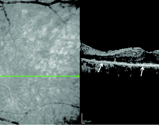 Sindromi masquerades: Optical coherence tomography di un soggetto affetto da linfoma vitreoretinico primario. Gli infiltrati linfomatosi sono evidenziati dalle frecce come materiale granulare iperriflettente sottoretinico e sotto l’epitelio pigmentato.