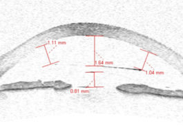anisometropia miopica