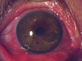 Cheratite neurotonica