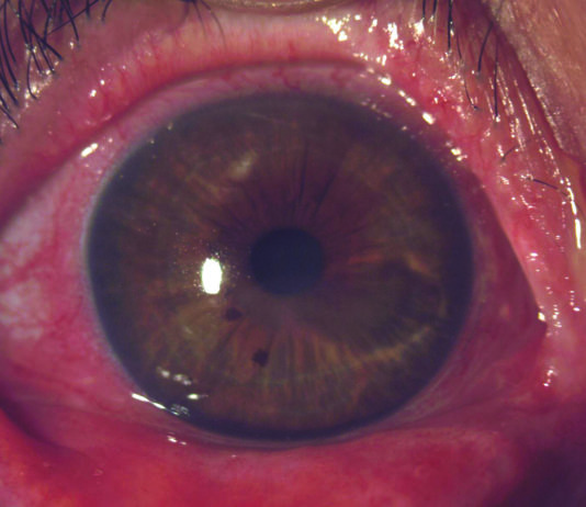 La cheratite neurotrofica: un caso clinico Cheratite neurotonica