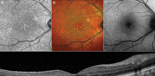 L’utilizzo del laser sottosoglia nella degenerazione maculare secca degenerazione maculare