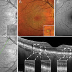 paziente-affetto-da-pseudodrusen