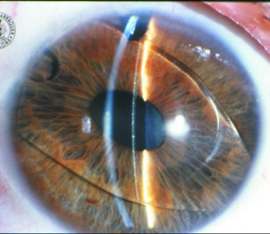 La correzione della miopia elevata con IOL fachiche nella storia