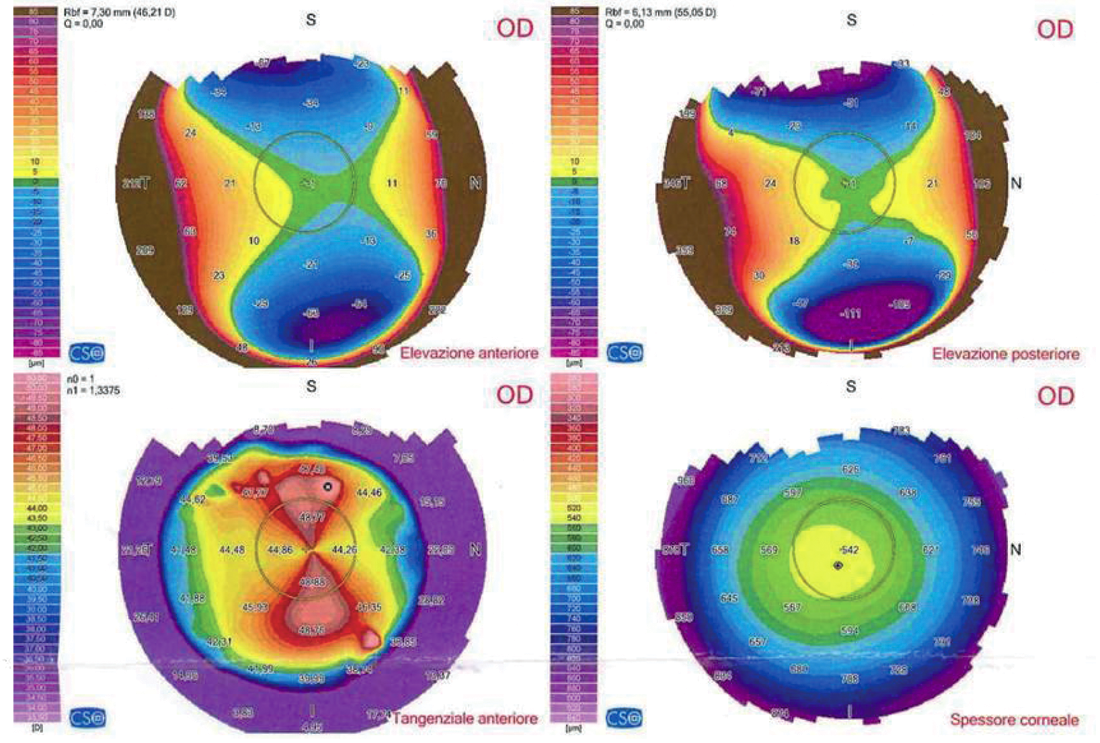 Anisometropia-miopica-1
