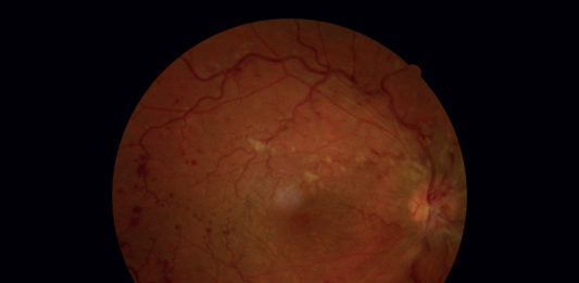 Paziente con occlusione della vena centrale della retina: work-up diagnostico Fotografia del fondo oculare dell’occhio destro.
