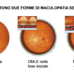 maculopatia