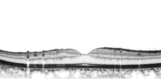 Glaucoma e miopia: due patologie su cui aprire gli occhi