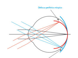 Fig. 4. Rappresentazione del defocus periferico miopico (rosso) e ipermetropico (blu) quando viene osservato un oggetto posto all’infinito ottico e la cui immagine cade in fovea.