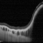 Figura 4. Bscan eseguita sulla lesione.