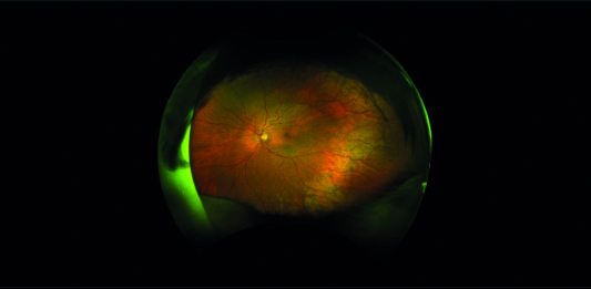 Fig. 1. Immagini wide-field del funds oculi.