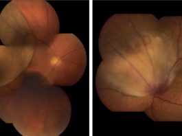 Melanoma oculare