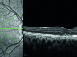 Neovascolarizzazioni coroideali nelle infiammazioni oculari Neovascolarizzazioni coroideali