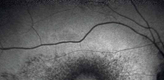 Retinopatia da idrossiclorochina Retinopatia da idrossiclorochina