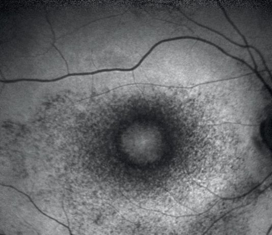 Retinopatia da idrossiclorochina