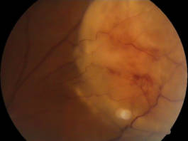 Diagnosi e trattamento di metastasi coroideale Fig. 1 Formazione della corioretina posteriore.