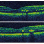 Esame-OCT-che-evidenzia-essudati-nel-contesto-retinico