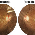 Fundus-oculare-con-stella-maculare-tipica-in-OD