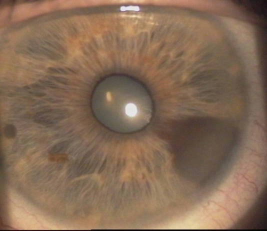 Oncologia oculare oncologia oculare