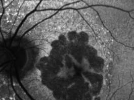 Fig. 2C: Autofluorescenza del fondo a luce blu. Stesso paziente affetto da GA: progressione a 4 anni.