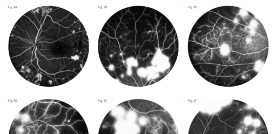 Vitrectomia precoce nella retinopatia diabetica proliferante: i fattori determinanti