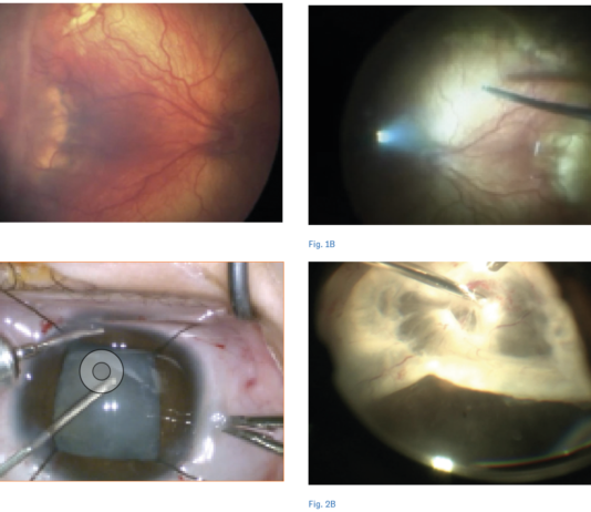 Fig. 1 Paziente con retinopatia del prematuro stadio 4. Foto fundus preoperatoria (Fig. 1A), immagine intraoperatoria durante vitrectomia (Fig. 1B). Fig. 2 Paziente con retinopatia del prematuro stadio 5. Immagine intraoperatoria durante lensectomia per via limbare (Fig. 2A), dissezione delle membrane (Fig. 2B).