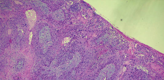 Le neoplasie palpebrali e perioculari